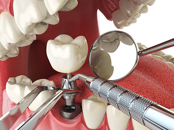 Best Emergency Dentist for Knocked-Out Tooth in Pevely, MO